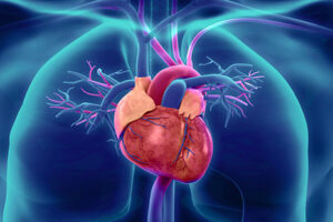 Infarto