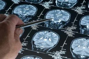 Alzheimer e IA